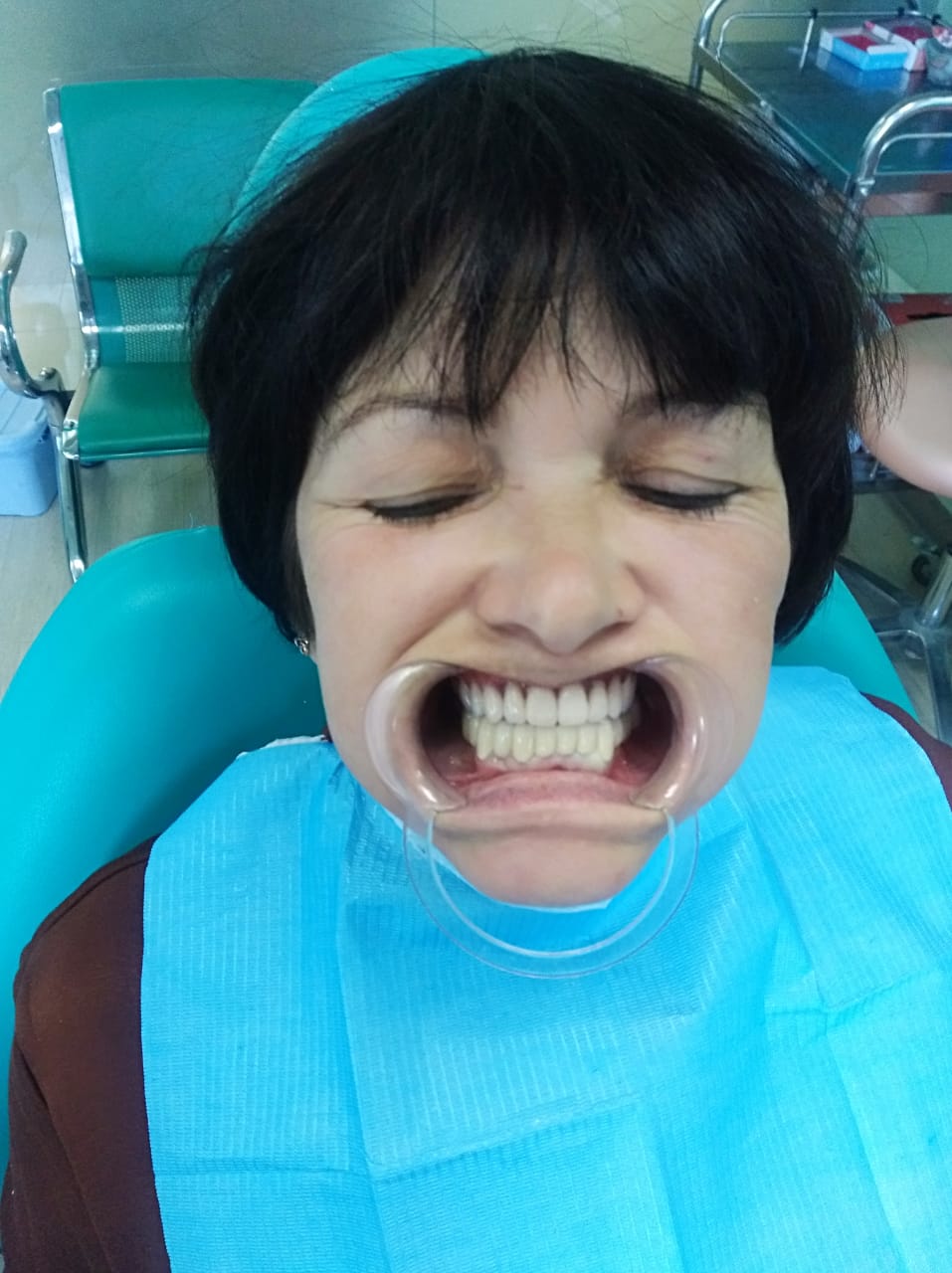до и после  как вставили зубы в Китае
